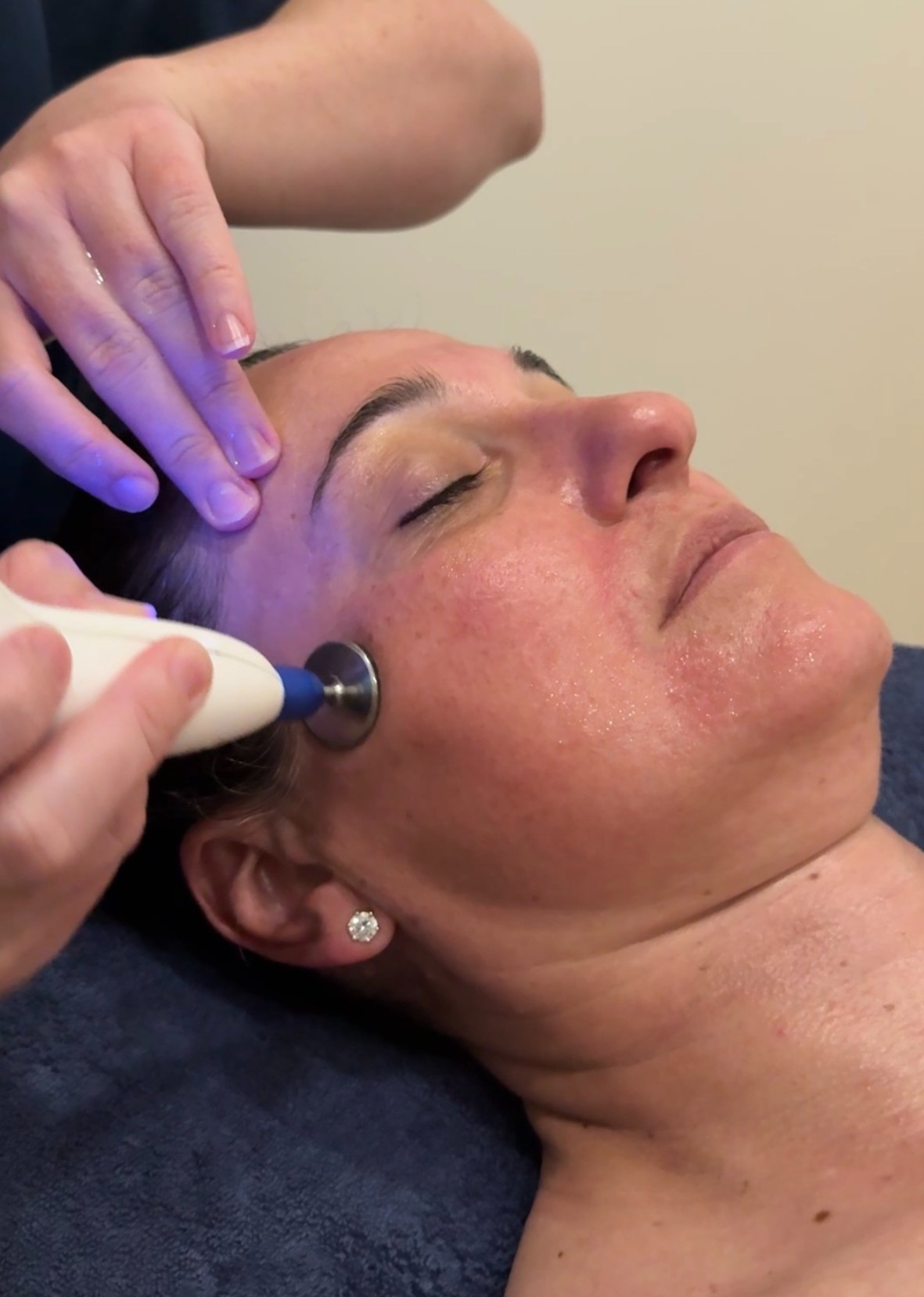 Dotless Plasma - Results Without Downtime